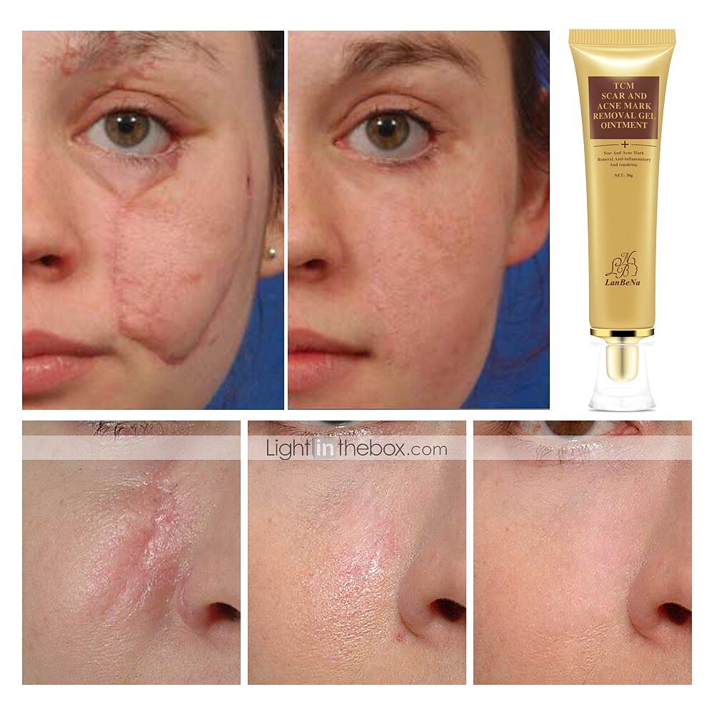 2021年 ランベナにきび傷跡除去クリーム肌修理顔クリームにきびスポットにきび治療にきびホワイトニングクリームストレッチマーク30 Ml 7737211 コレクション 15 20