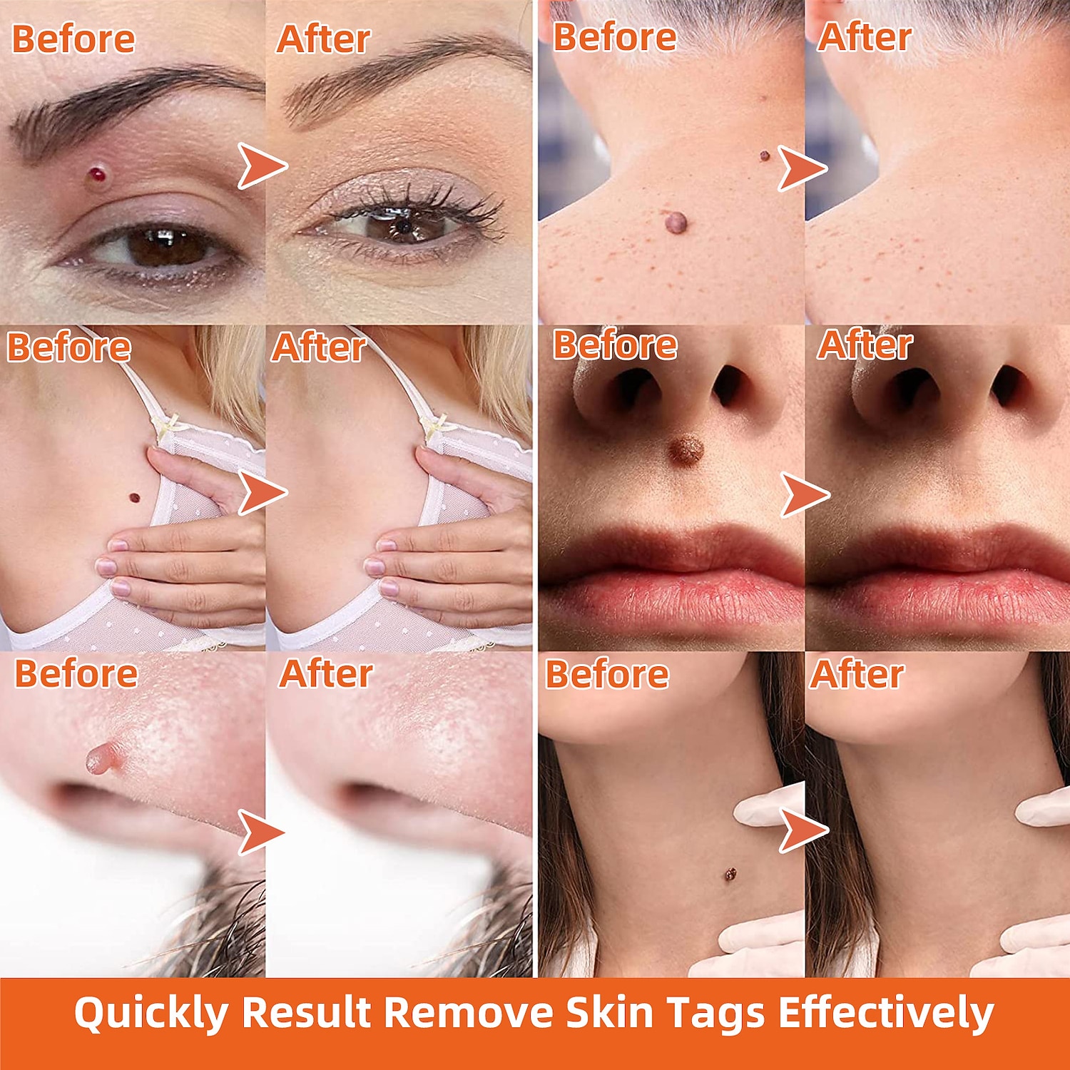 Painless Safe Skin Tag Remove Device Kit Micro Tags Size (2mm to 4mm) Warts Remover Original Skin Band Tool Set 2026 - $10.49 –P6