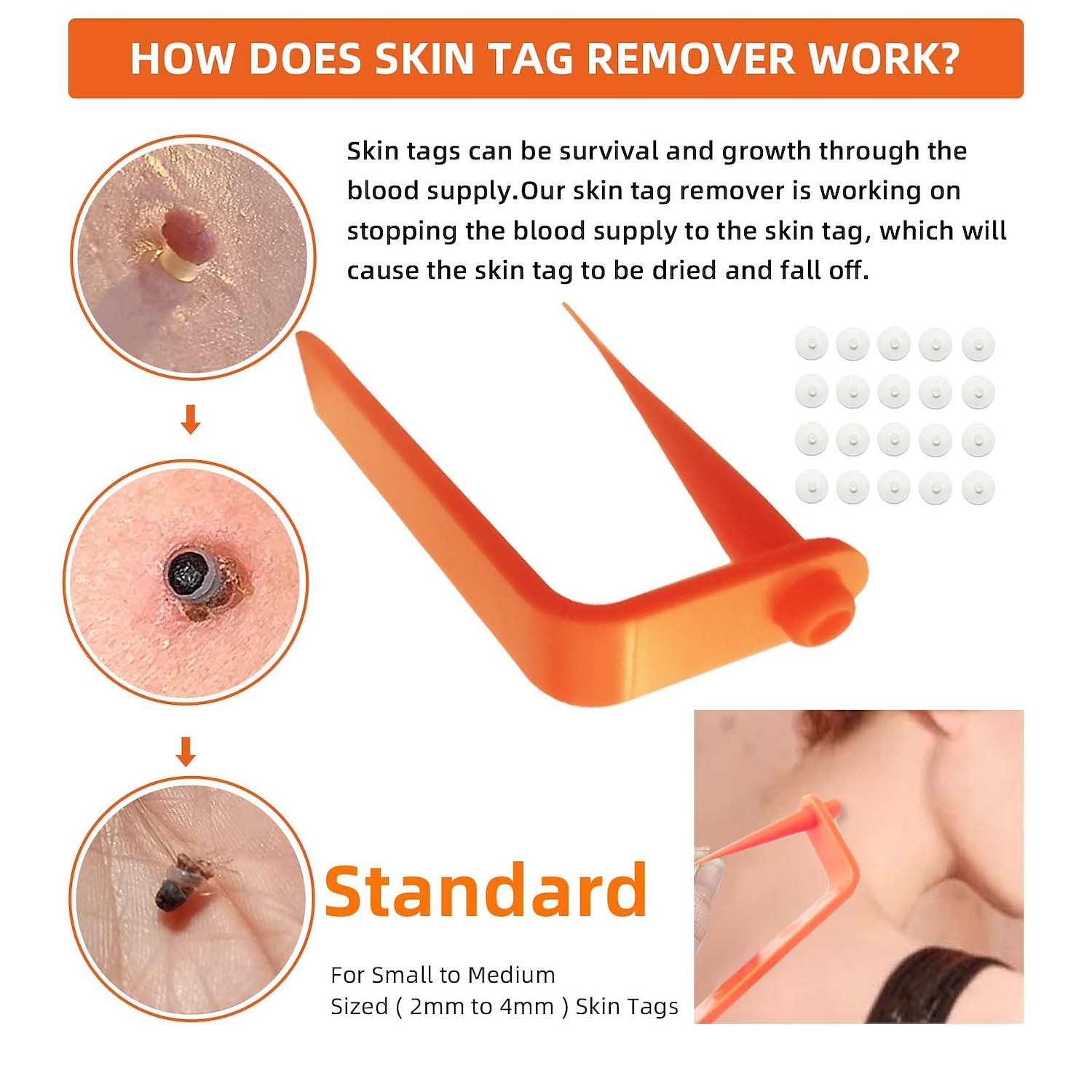 Painless Safe Skin Tag Remove Device Kit Micro Tags Size (2mm to 4mm) Warts Remover Original Skin Band Tool Set 2026 - $10.49 –P4