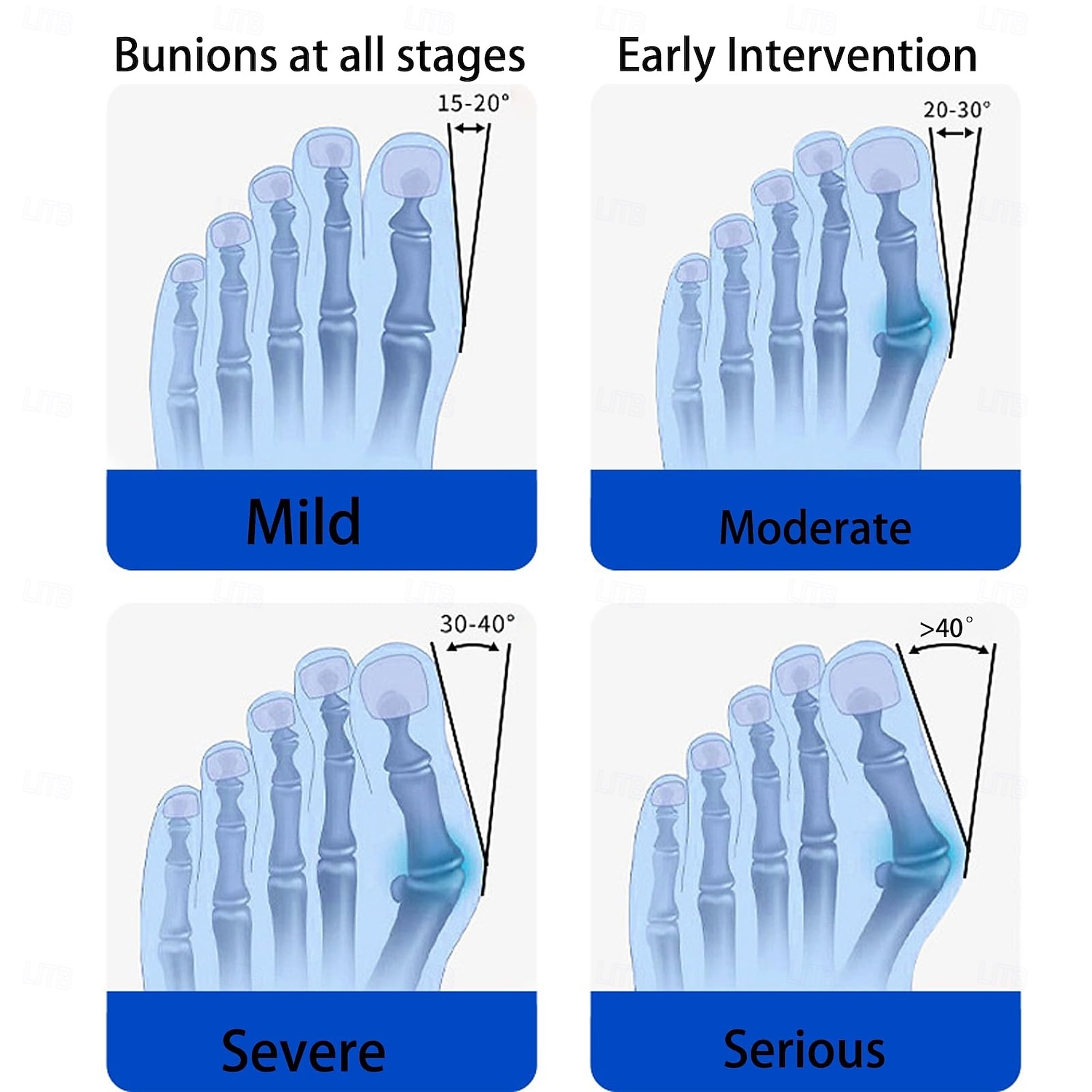 Bunion Corrector for Women Men Big Toe,Adjustable Knob Bunion Corrector for Bunion Relief,Bunion Fix with Bunion Silicone Pad,Suitable for Left and Right Feet 2025 - $20.99 –P5
