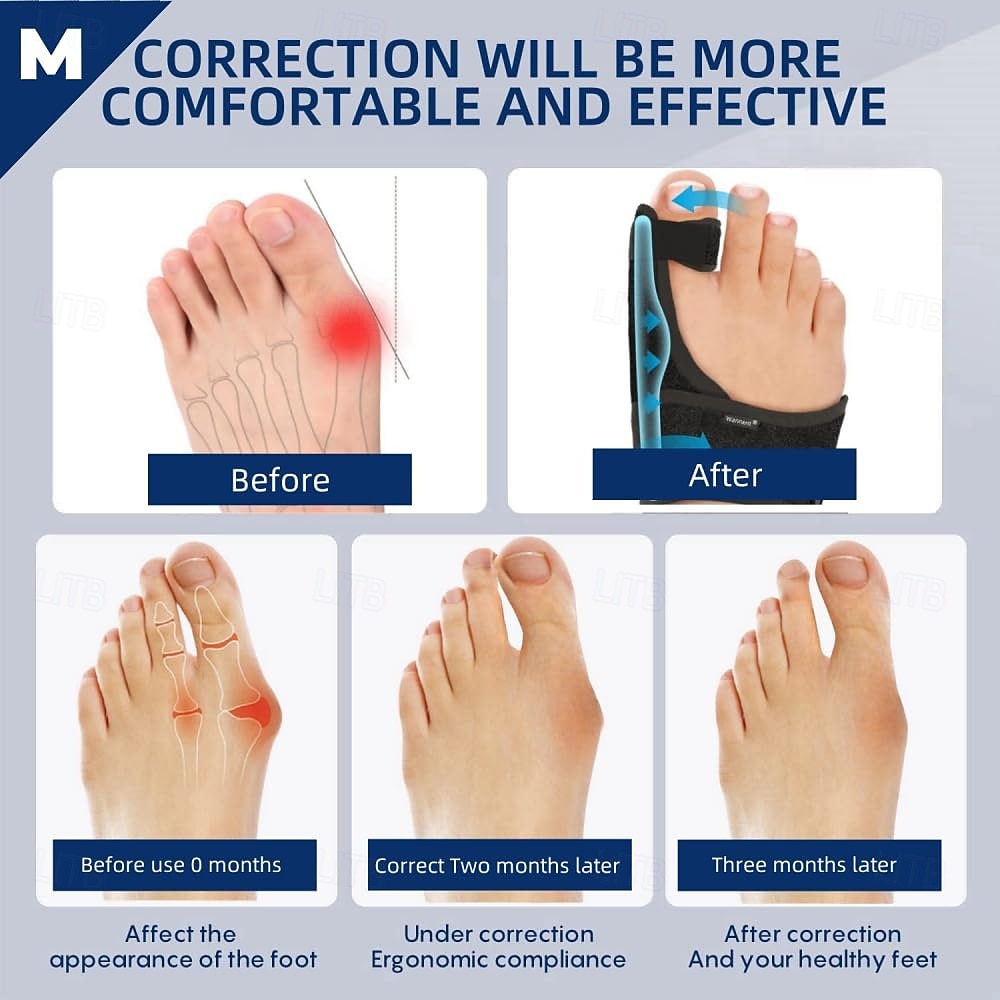 Bunion Corrector for Women Big Toe Straightener Orthopedic Bunion Splint Non Surgical Hallux Valgus Correction Hammer Toe Straightener Comfortable Breathable for Day Night 2026 - $24.99 –P4