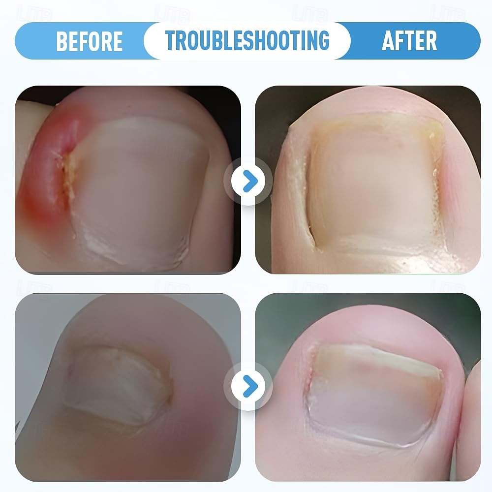 12 pezzi di cerotti per la rimozione dei calli per piedi e mani – cerotto per la rimozione delle verruche e dei calli per la pelle dura, cerotti plantari per i piedi, cerotto per calli per calli e del 2026 a $13.49 –P2