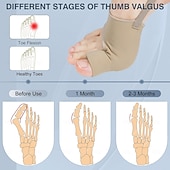abordables Attelles et orthèses-Lot de 2 correcteurs d&#039;oignon pour femmes et hommes, chaussettes pour oignons, correcteur d&#039;orteils, confortables, respirants pour un soutien de jour/nuit, soulagement de la douleur de l&#039;hallux