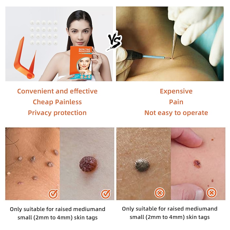 Painless Safe Skin Tag Remove Device Kit Micro Tags Size (2mm to 4mm) Warts Remover Original Skin Band Tool Set2