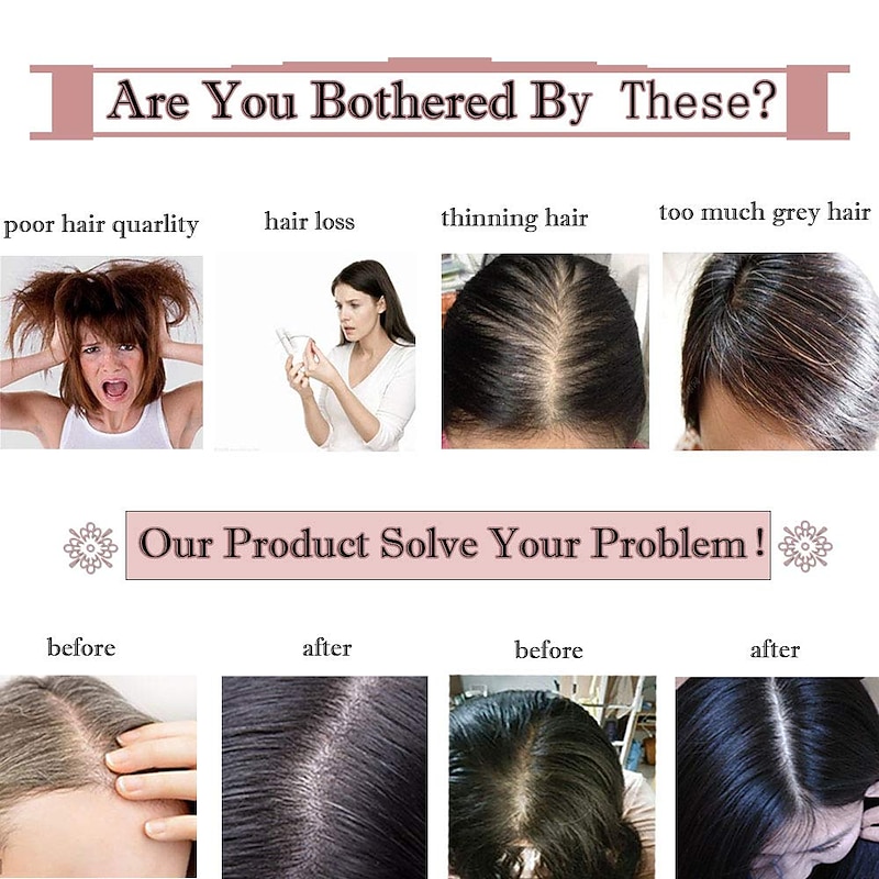 6 Inch 100% Remy Human Hair Silk Base Top Hairpiece for Women Clip in Topper Hand-made Top Toppee Hair piece 120% Density Middle Part with Thinning Hair #4P27 Medium Brown&Dark Blonde 27g3