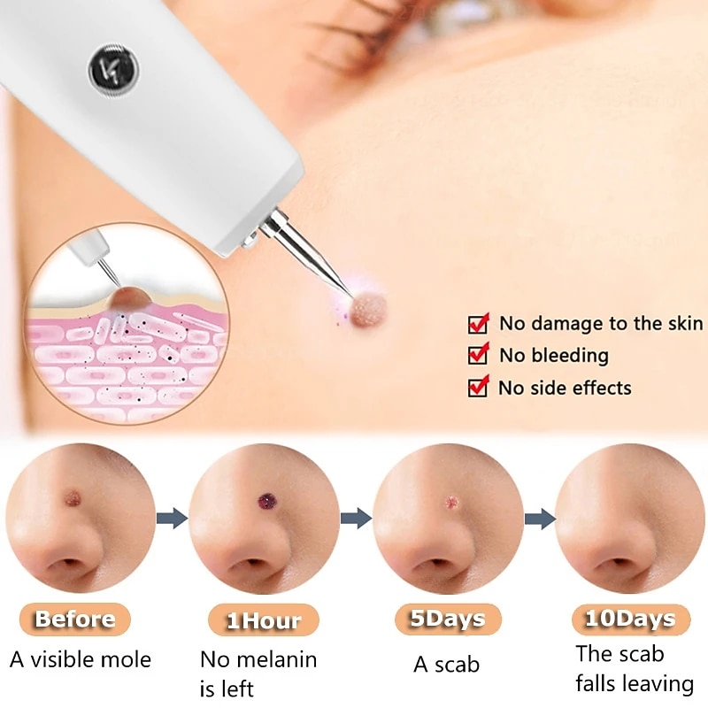 Skin Tag Remover 15 Level Laser Plasma Pen Freckle Mole Warts Removal Lcd Nevus Tattoo Black Spots Remover Blemish Removal4
