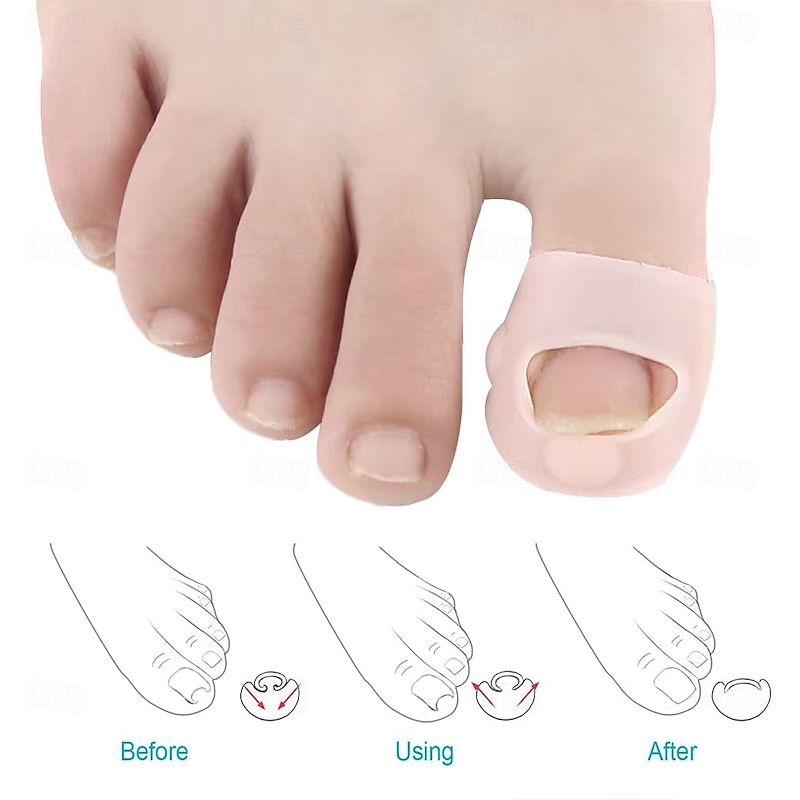 2PCS Silicone Ingrown Toenail Corrector – Invisible Toe Nail Straightening Brace, Pedicure Foot Care Tool for Paronychia Treatment & Nail Healing Protection2
