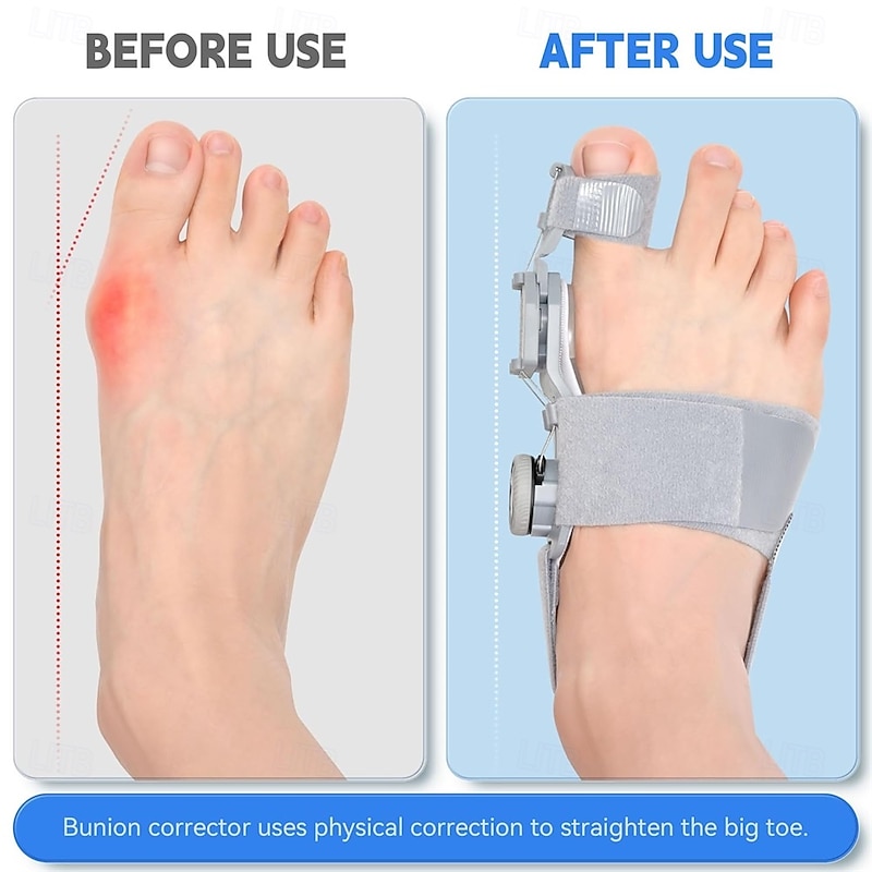 Bunion Corrector for Women Men Adjustable Universal Size Bunion Splint Big Toe Straightener Toe Separators for Bunions with 2 Silicone Pads Better Fit to the Toes Without Damaging the Skin2